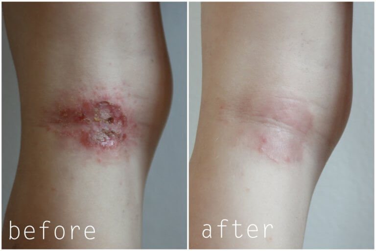 eczema legs before and after